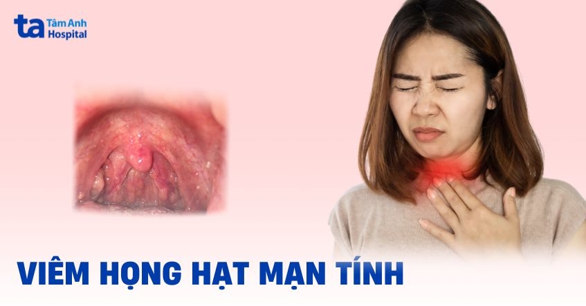 Viêm họng hạt mạn tính: Triệu chứng, điều trị và phòng ngừa