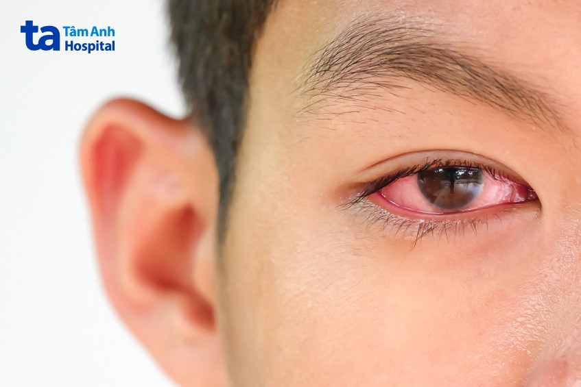 viêm kết mạc dị ứng theo mùa bị đỏ mắt