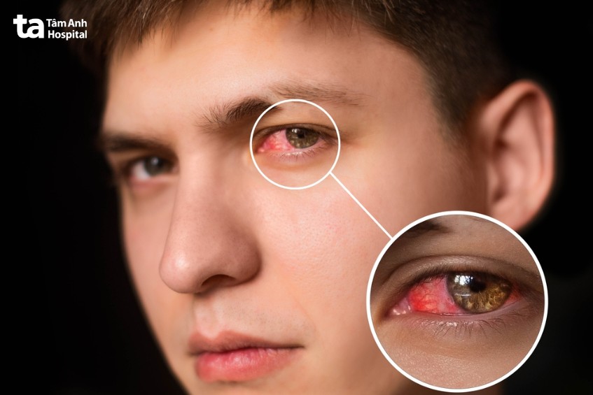 viêm kết mạc do virus là đau mắt đỏ
