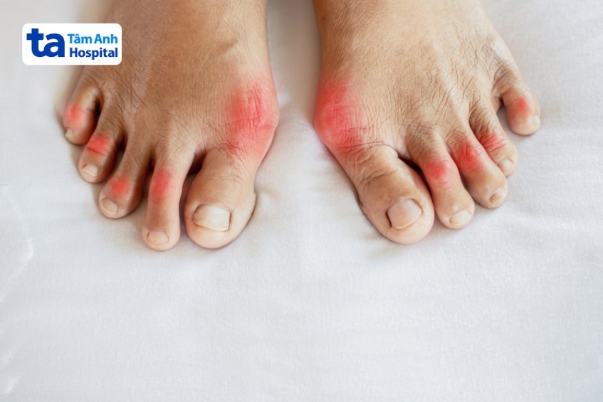 viêm khớp dạng thấp ảnh hưởng khớp bàn chân