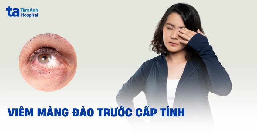 viêm màng bồ đào trước cấp tính