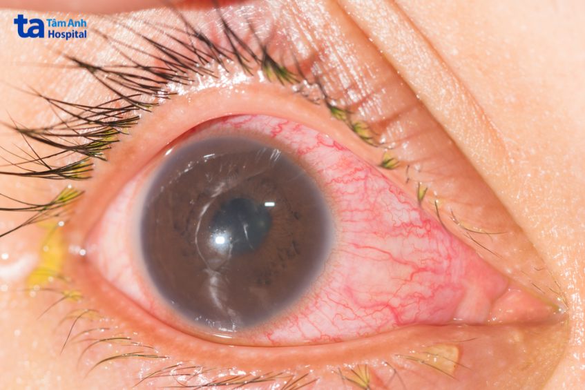 viêm màng bồ đào vẫn có thể điều trị