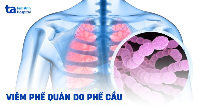Viêm phế quản do phế cầu: Nguyên nhân, triệu chứng và điều trị
