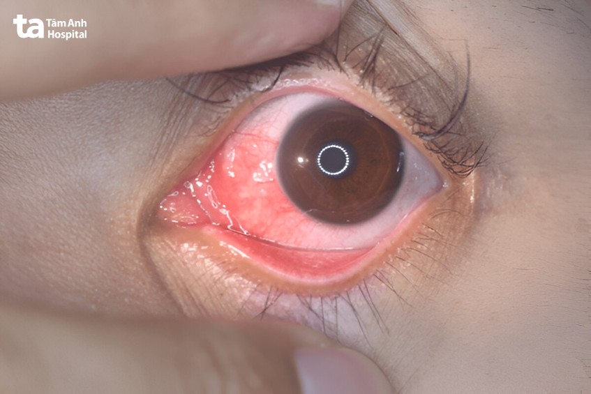 viêm thượng củng mạc không có dịch tiết