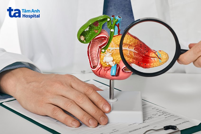 viêm tụy cấp nặng có thể gây biến chứng tràn dịch màng phổi