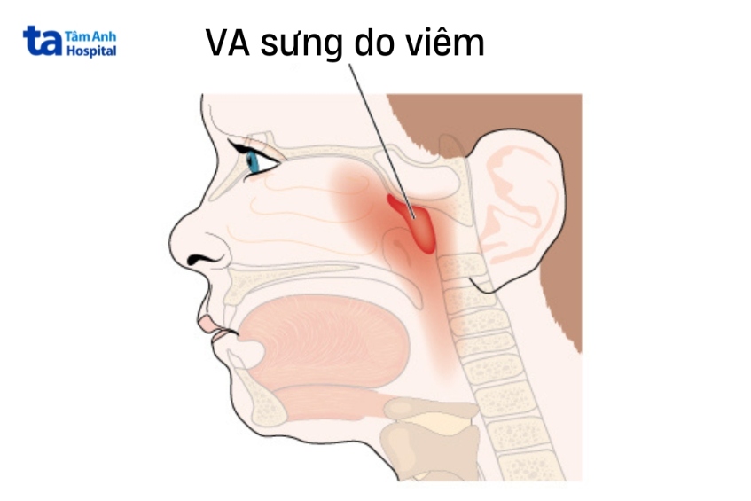 viêm va thường gặp ở trẻ em