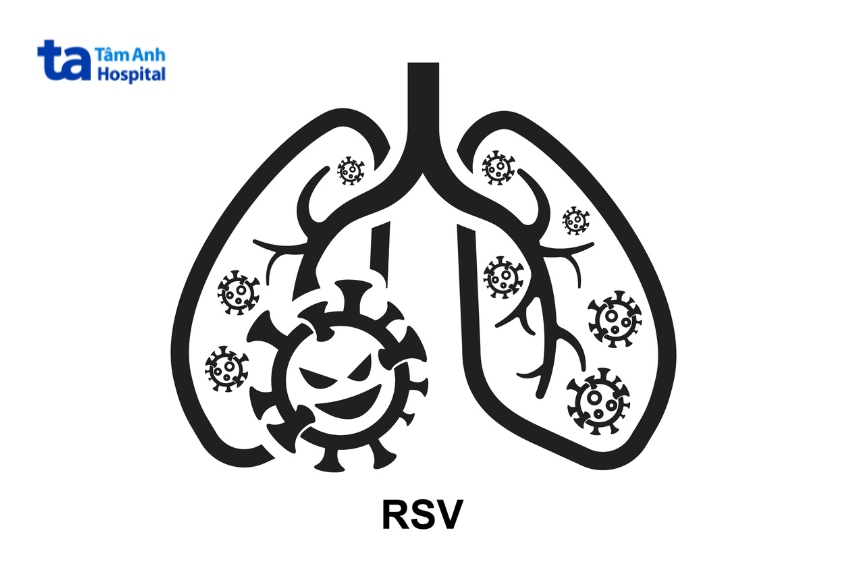 virus hợp bào hô hấp gây viêm tiểu phế quản