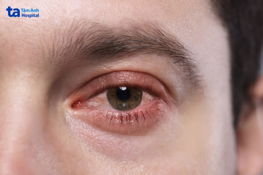 virus viêm kết mạc không ảnh hưởng thị lực