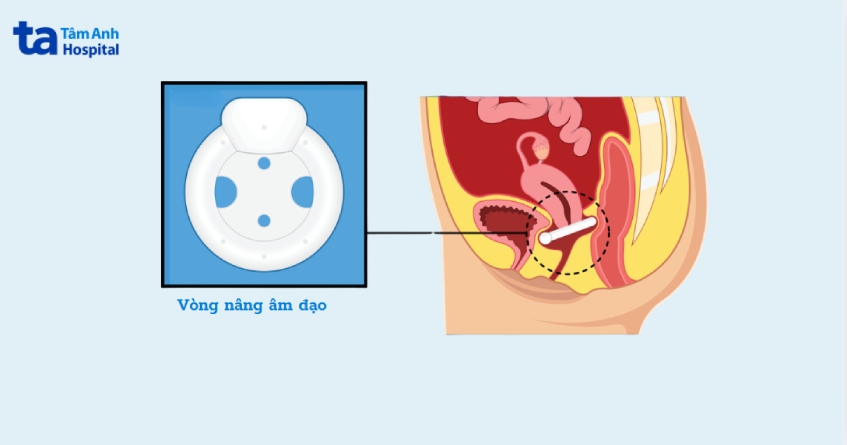 vòng nâng âm đạo trong điều trị sa sinh dục