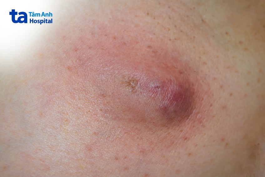 vùng da hạch viêm mạn tính