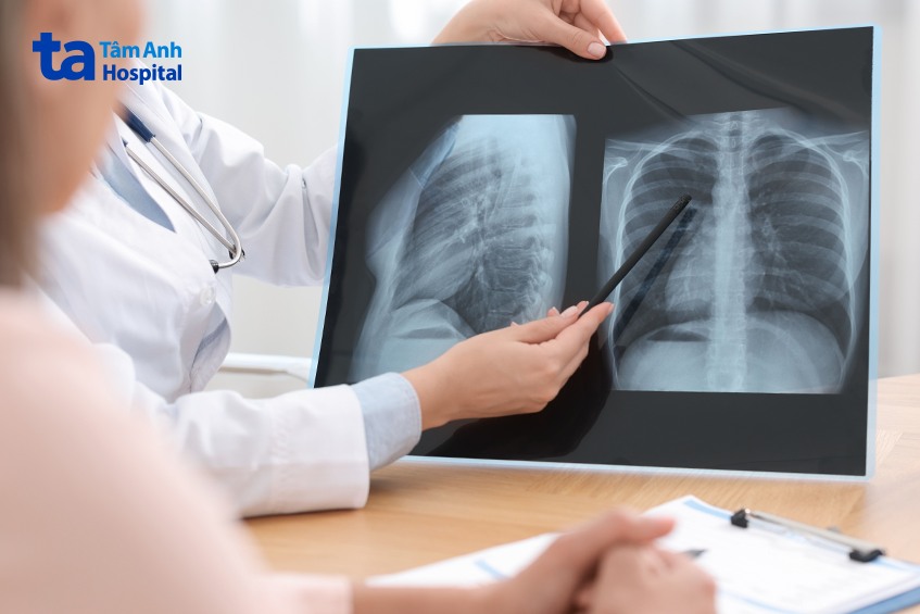 x quang ngực trước phẫu thuật cắt thuỳ phổi