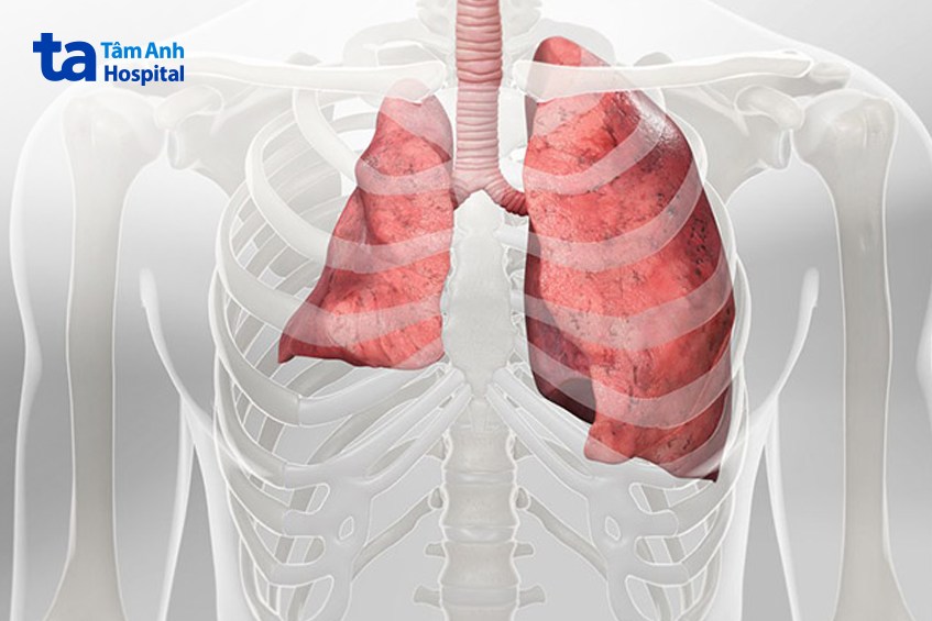 xẹp phổi là bệnh nguy hiểm và có thể gây ra nhiều biến chứng