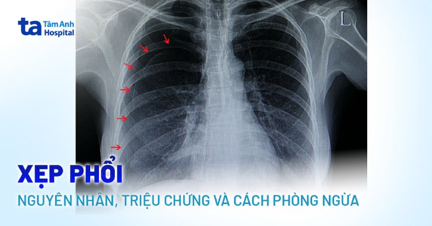 xẹp phổi