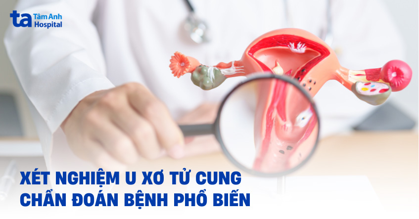4 loại xét nghiệm u xơ tử cung để chẩn đoán bệnh phổ biến hiện nay
