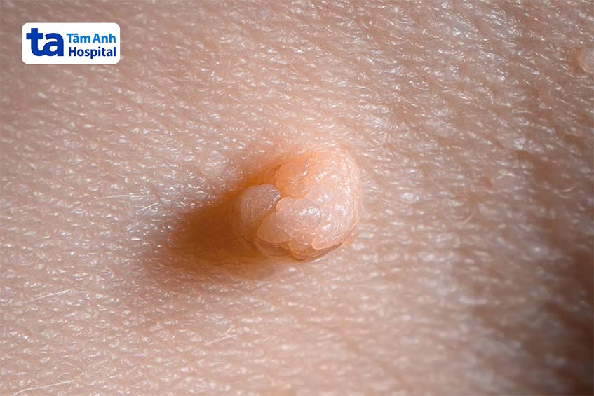 xu hướng mắc ngày càng trẻ hóa