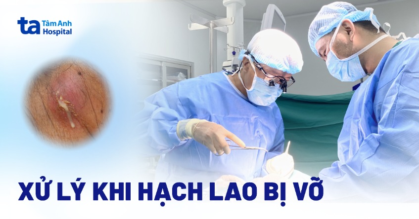 Hướng dẫn xử lý khi hạch lao bị vỡ đúng cách và lưu ý