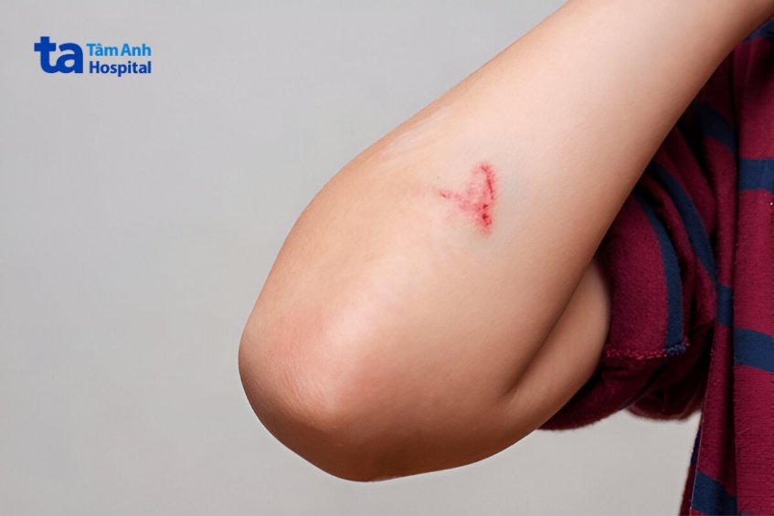 yếu tố ảnh hưởng đến khả năng tự khỏi bệnh vảy nến thể giọt