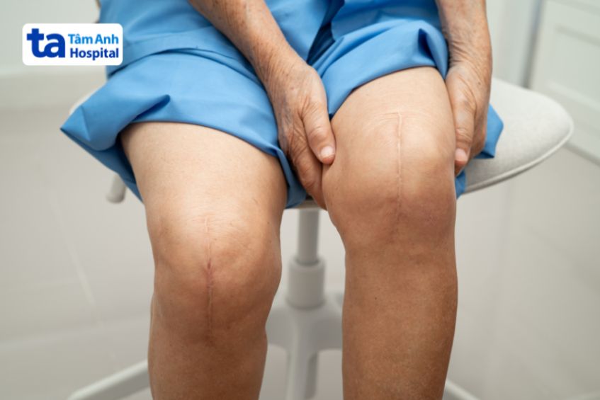 Yếu tố ảnh hướng thay khớp gối