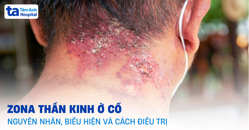 Zona thần kinh ở cổ: Nguyên nhân, biểu hiện và cách điều trị