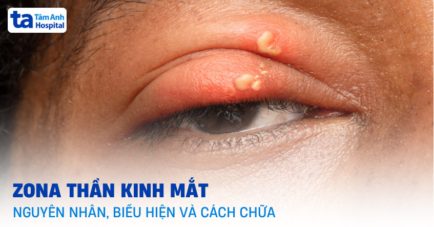 Zona thần kinh ở mắt: Nguyên nhân, biểu hiện và cách chữa