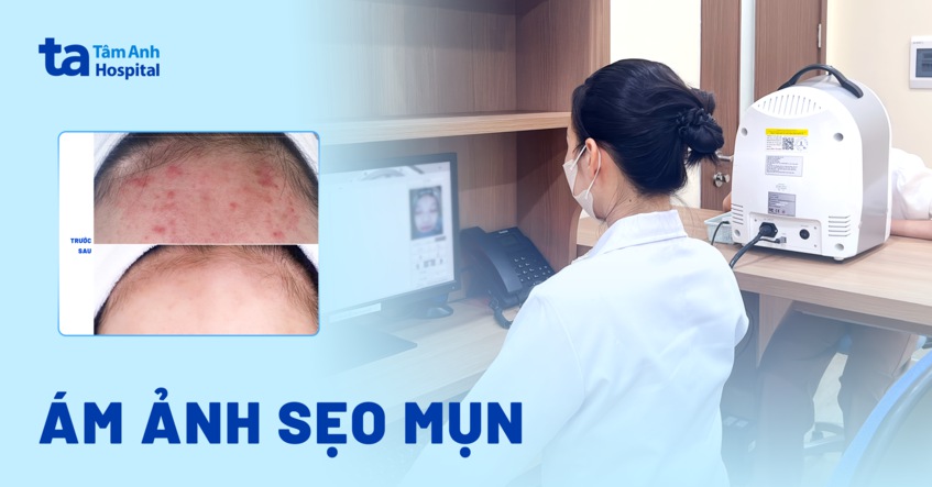 ám ảnh vì sẹo mụn