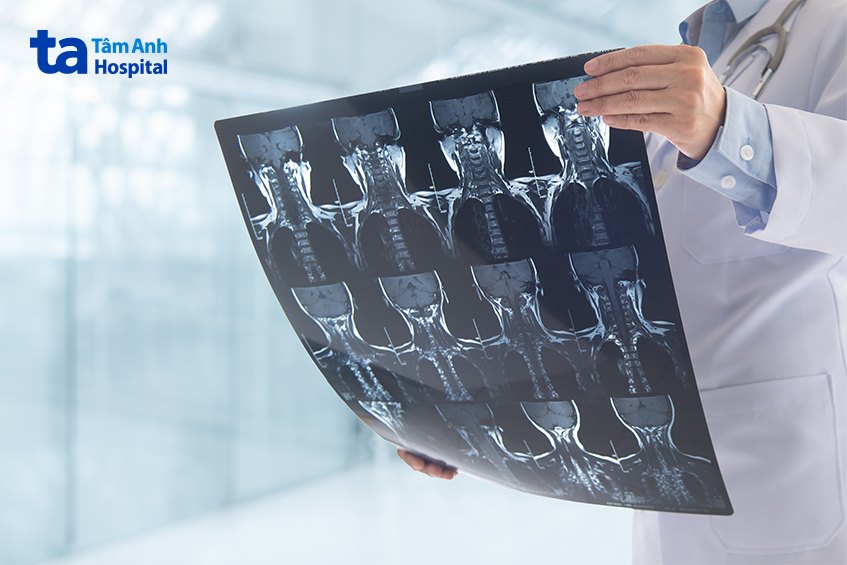 ảnh chụp ct cột sống