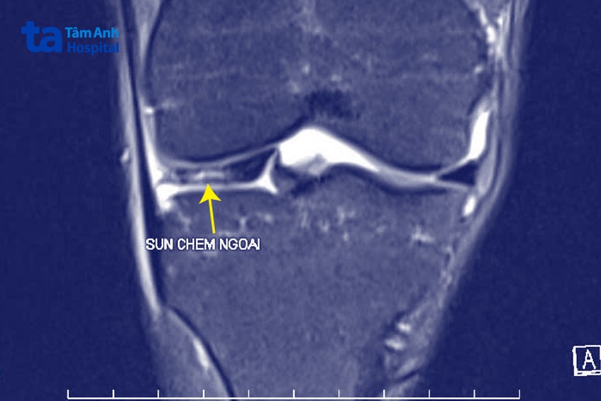 ảnh chụp mri của chị vân