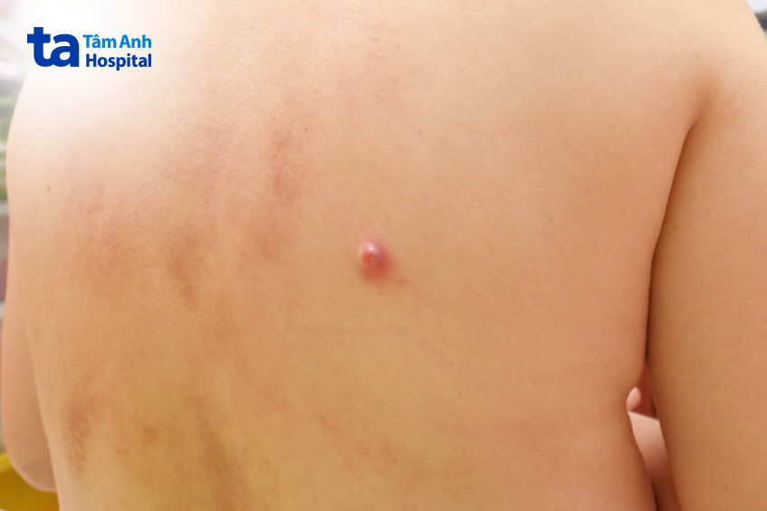 ảnh mụn nhọt thực tế (3)