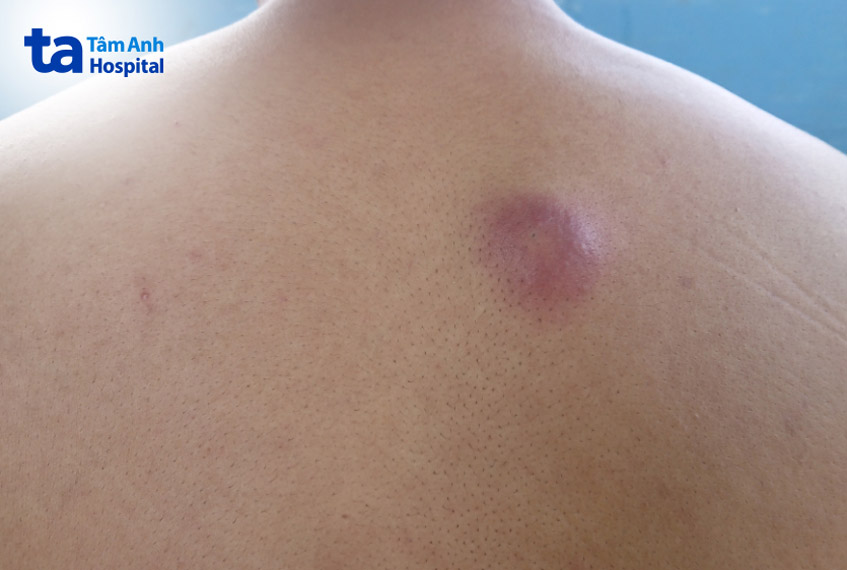 ảnh mụn nhọt thực tế