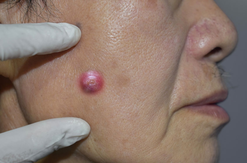 áp xe là biến chứng mụn nhọt