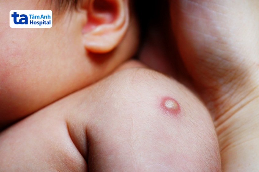 bé chích ngừa bị áp xe