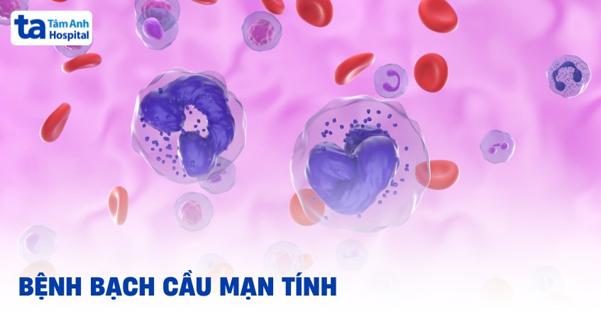 Bệnh bạch cầu mạn tính: Nguyên nhân, triệu chứng và chẩn đoán