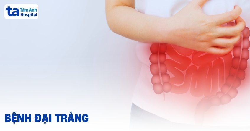 Bệnh đại tràng: Nguyên nhân, triệu chứng, chẩn đoán, điều trị