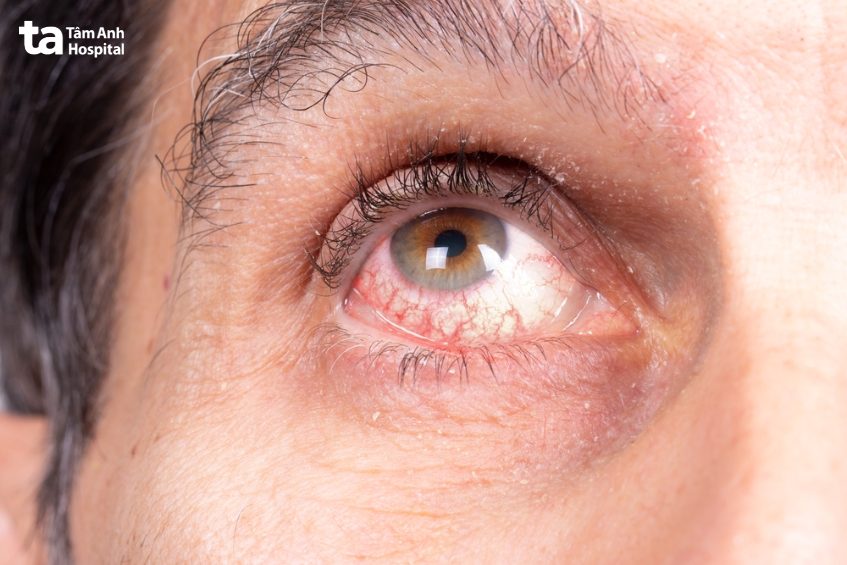 bệnh dễ nhầm lẫn với các bệnh khác