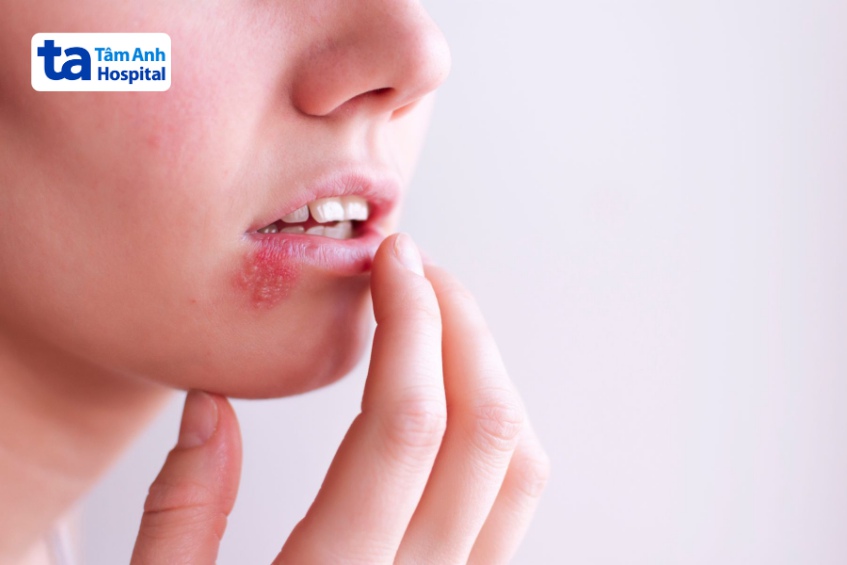 bệnh giời leo ở miệng