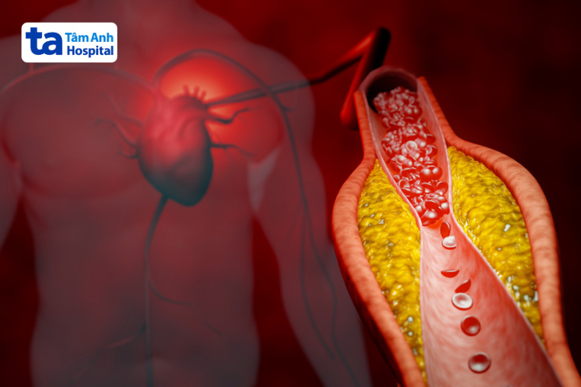 Bệnh mạch vành ở người cao tuổi làm tăng nguy cơ huyết áp không ổn định