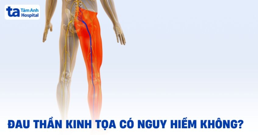 Đau thần kinh tọa có nguy hiểm không? Khi nào cần đến gặp bác sĩ?