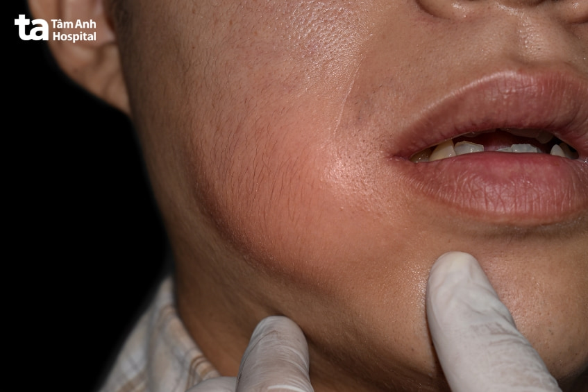 bị sưng nướu ở răng khôn