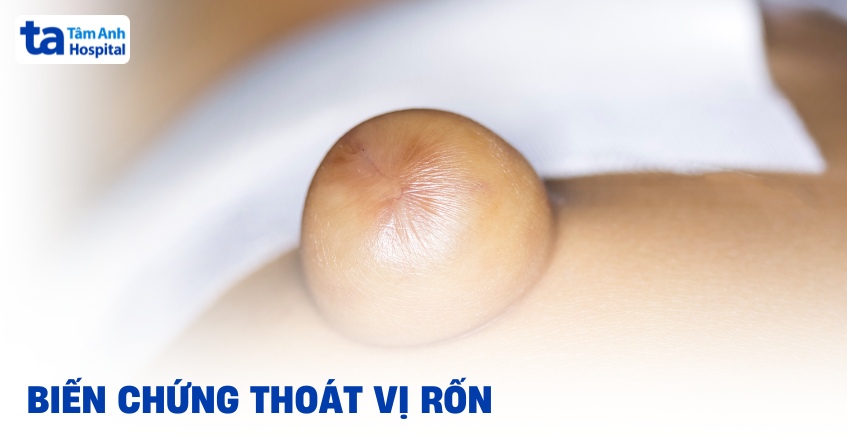 Biến chứng thoát vị rốn ở trẻ biết sớm để phòng ngừa