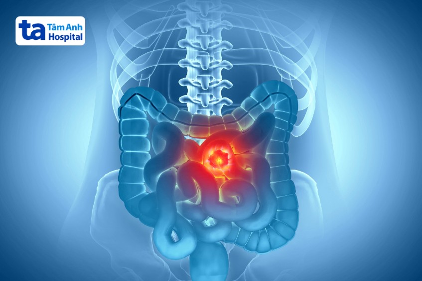 biến chứng viêm đại tràng