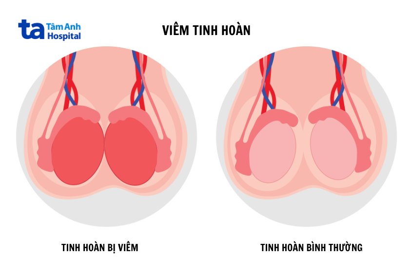 biến chứng viêm tinh hoàn và buồng trứng