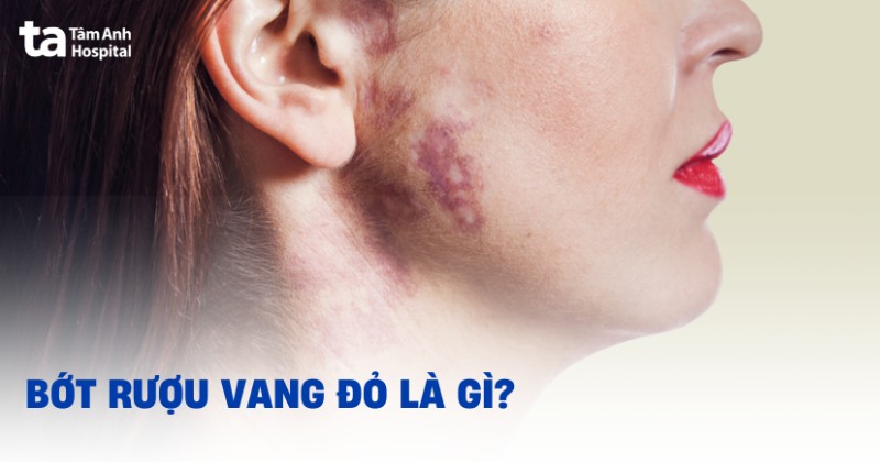 Vết bớt rượu vang đỏ: Hình ảnh, triệu chứng và giải pháp điều trị
