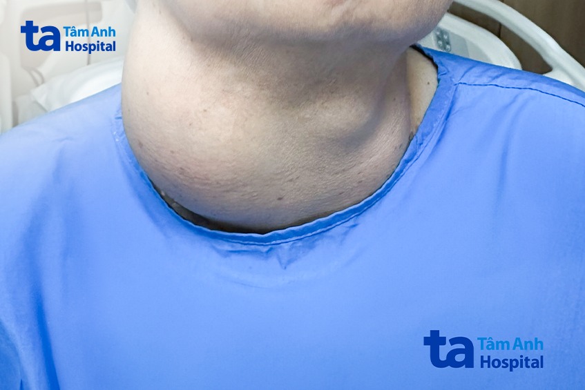 bướu cổ bà h trước khi phẫu thuật