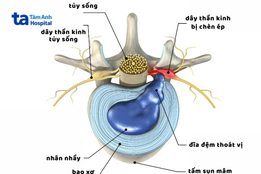Các bệnh lý đĩa đệm thường gặp