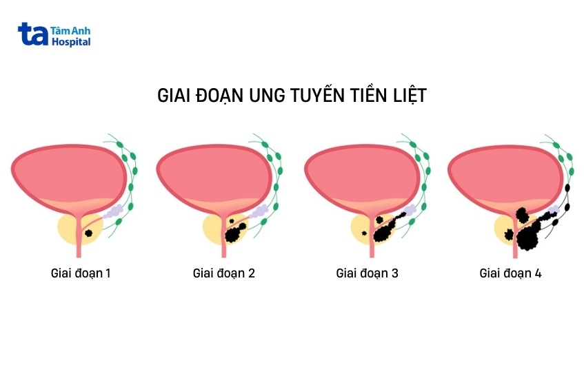 các giai đoạn bệnh ung thư tuyến tiền liệt