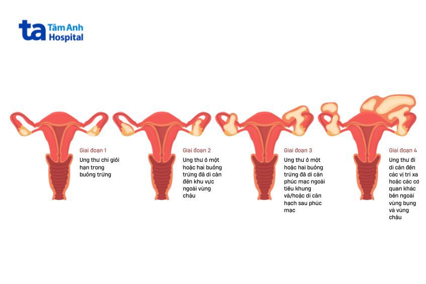 Các giai đoạn của u nang buồng trứng ác tính