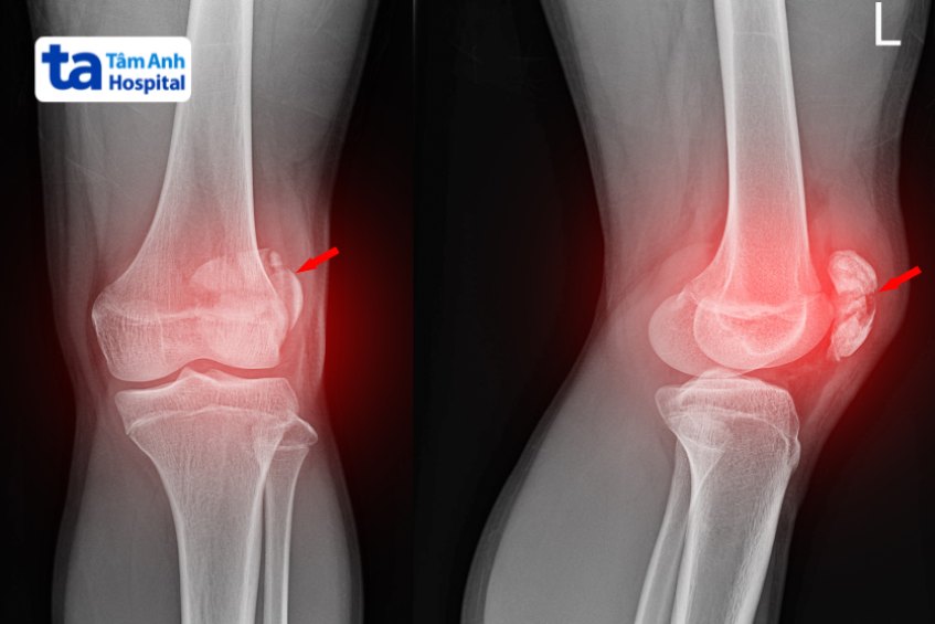 Các loại chấn thương đầu gối khi đá bóng