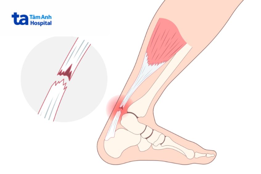 Các loại chấn thương gân Achilles