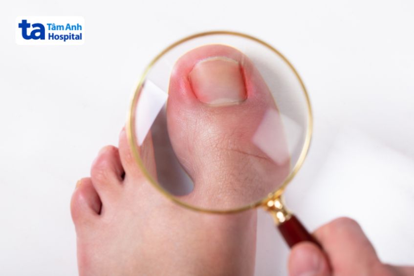 Các loại chấn thương ngón chân