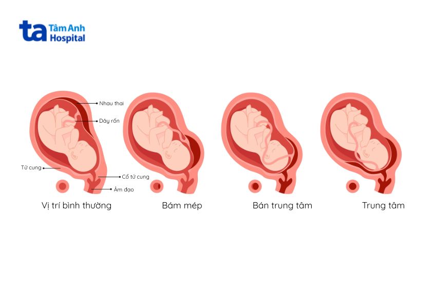 Rau tiền đạo trung tâm nguy hiểm nhất trong các loại rau tiền đạo bởi bánh nhau che phủ hoàn toàn lỗ trong cổ tử cung